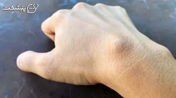 کیست چیست؟-پزشکت